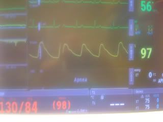 Basilic Vein Transposition